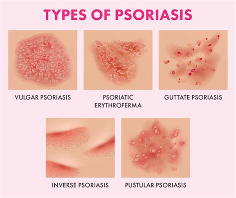 dating for psoriasis sufferers